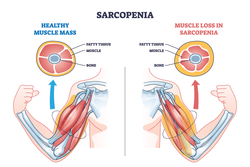 Illustration comparing healthy muscle mass to muscle loss in sarcopenia, highlighting the presence of fatty tissue, muscle, and bone in both scenarios.
